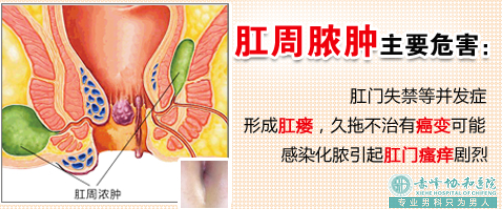 大连开发区痔疮医院：肛周脓肿有哪些症状?