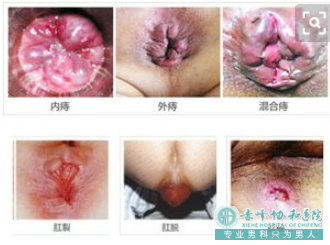 大连开发区元宝山区肛周脓肿常见的症状是哪些