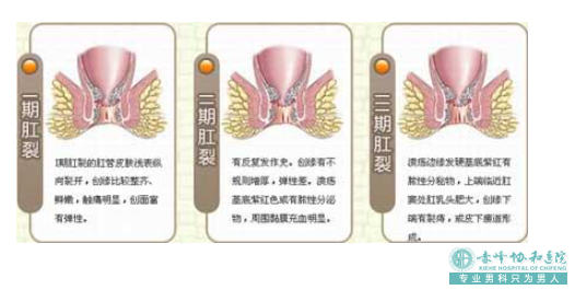 大连开发区敖汉旗不良生活习惯诱发肛肠疾病
