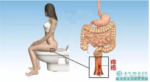 大连开发区林西县女性怎么预防肛周脓肿？