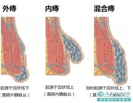 在大连开发区元宝山区痔疮治疗需要多少钱？