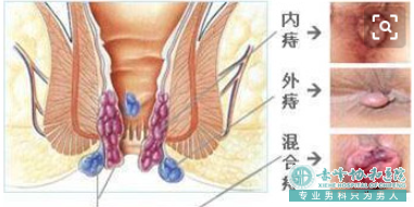 大连开发区元宝山区肛瘘发生的原因
