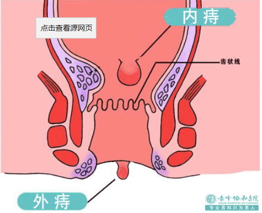 大连开发区松山区得了肛瘘会有哪些症状表现？