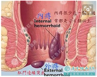 大连开发区宁城县肛周脓肿初期症状是什么