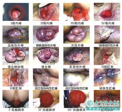 大连开发区肛肠医院：肛周脓肿的常见五大危害?