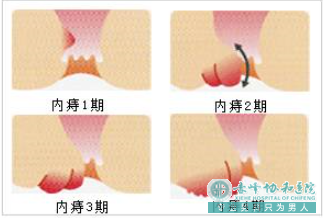 大连开发区克什克腾旗生痔疮有什么症状？