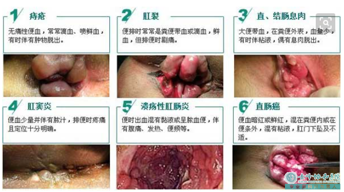 大连开发区敖汉旗患上肛瘘的原因是什么？